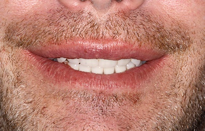 Smile gallary image - After